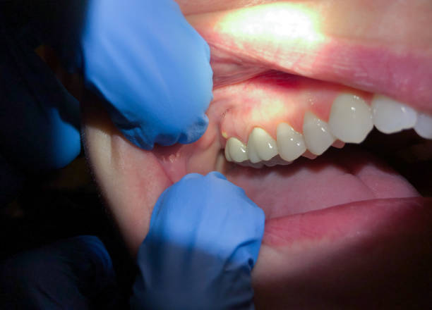 Best Emergency Root Canal Treatment in Severna Park, MD