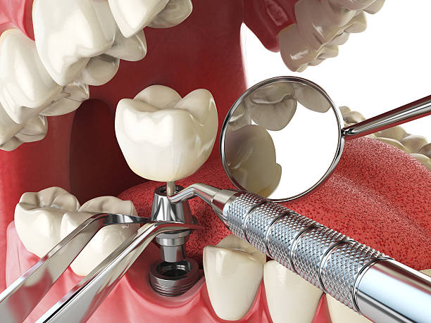 Best Emergency Treatment for Toothache in Severna Park, MD